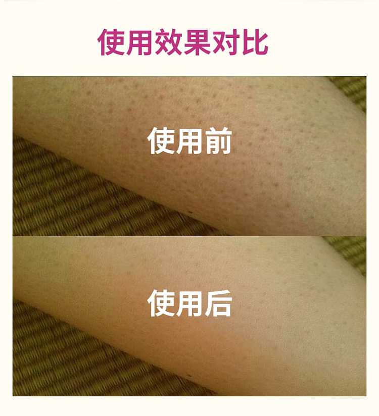 kobayashi-pharmaceutical-goose-bump-removal-ointment-30g-4
